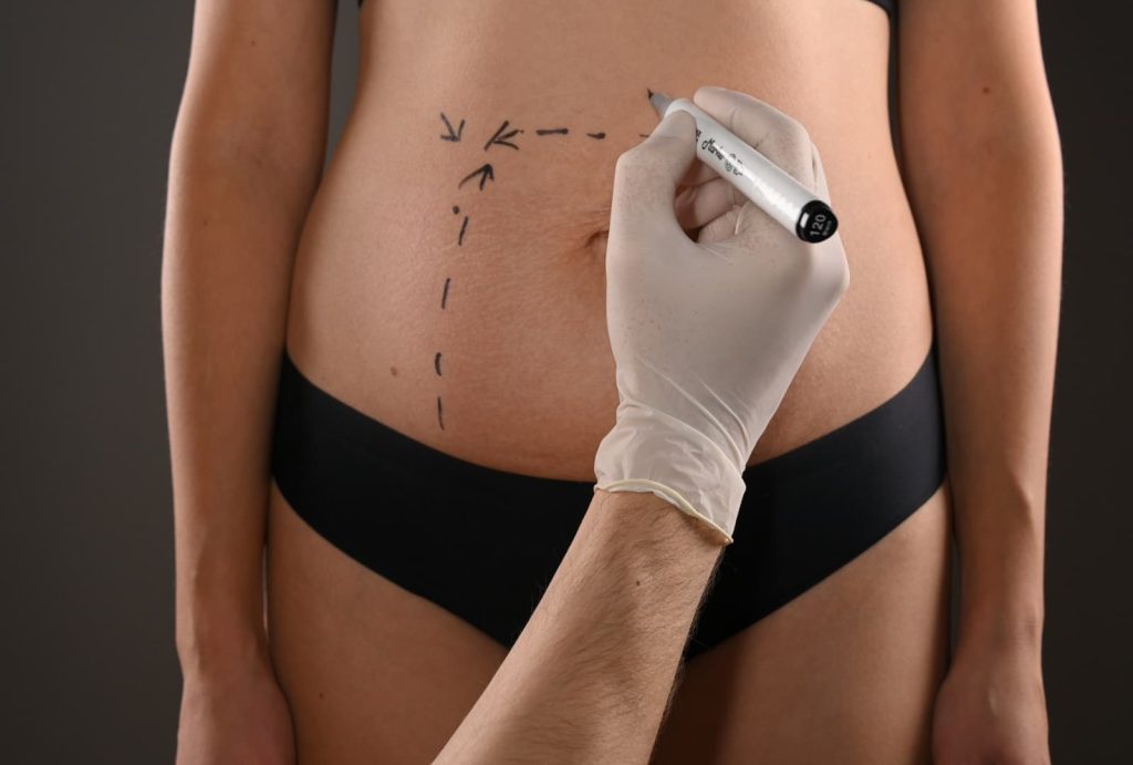 Abdominoplastia - Cirugía plástica y estética - Corporal Abdomen/Cintura