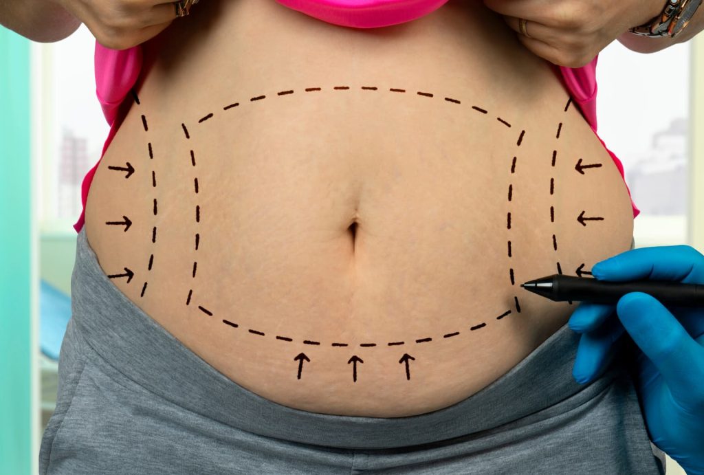 Lipoescultura tercio superior - Cirugía plástica y estética - Corporal Abdomen/Cintura