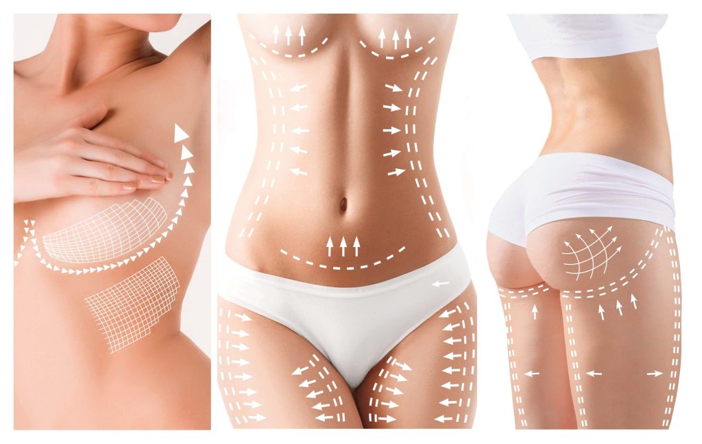 Liposucción HD en Marbella